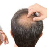 Prodotti anticaduta per capelli: funzionano davvero?