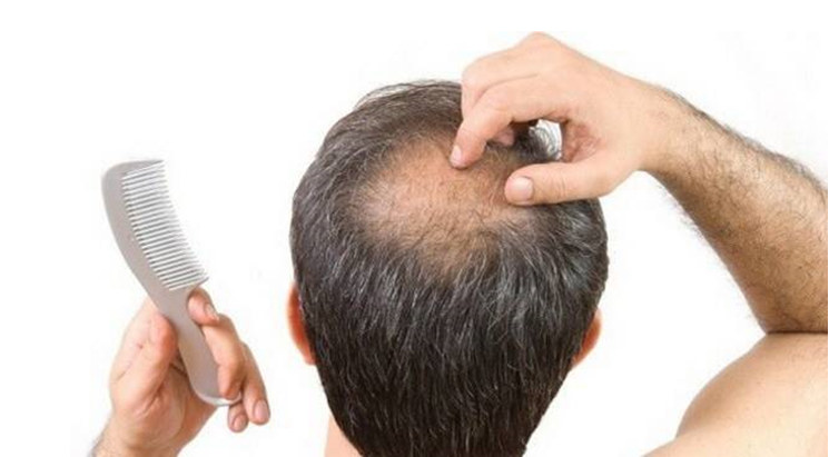 Prodotti anticaduta per capelli: funzionano davvero?